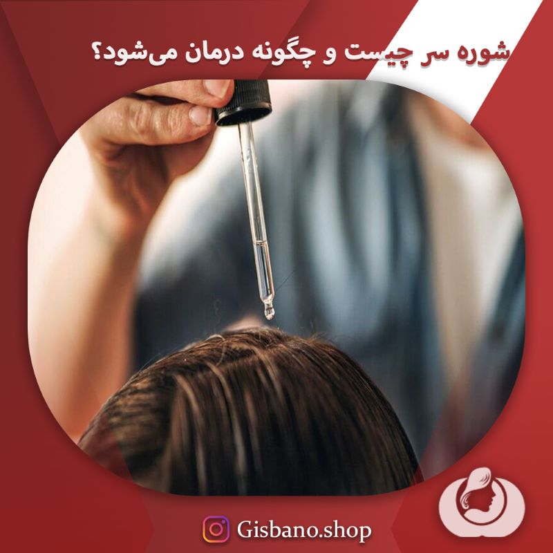 شوره سر چیست؟