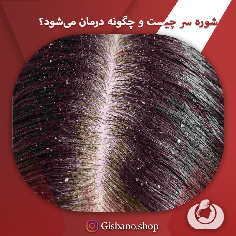 شوره سر چگونه درمان می شود؟